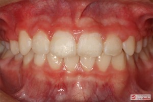Widok zębów w zwarciu po leczeniu od frontu