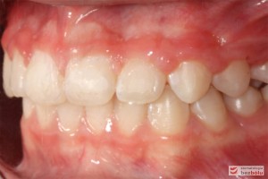 Widok zębów w zwarciu - strona lewa po leczeniu