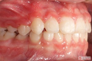 Widok zębów w zwarciu po stronie lewej po leczeniu