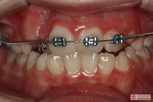 Widok zębów w dniu założeniu aparatu Widok zębów w dniu założeniu aparatu