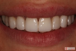 Pozytywna przemiana uśmiechu - obraz kliniczny po terapii stomatologicznej