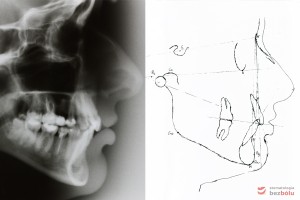 Analiza profilu twarzy wg Ricketts'a, prawidłowa pozycja szczęki i dotylna pozycja żuchwy względem czaszki, siekacz zbyt wychylony