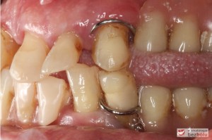 Starte, znoszone, osiadające protezy zębowe - widok po stronie lewej