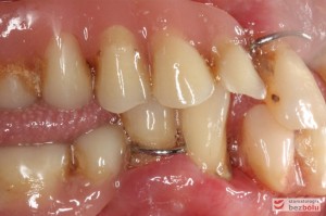 Starte, znoszone, osiadające protezy zębowe - widok po stronie prawej