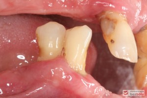 Stan wyjściowy - bez protez, liczne braki zębowe i po 2 nierokujące zęby w szczęce i żuchwie
