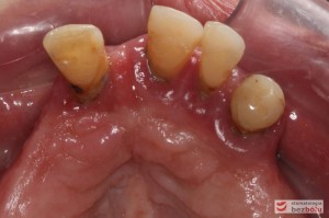 Stan wyjściowy - bez protez, liczne braki zębowe i po 2 nierokujące zęby w szczęce i żuchwie