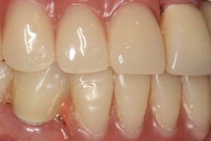 Ostateczny efekt terapeutyczny Ostateczny efekt terapeutyczny