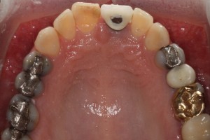 Powierzchnia okluzyjna zębów górnych