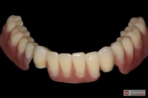 Odbudowa protetyczna żuchwy - wykonana przy użyciu zębów Michał Anioł Integrale