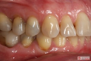 Przebarwienia zębów w strefach bocznych - sięgały zębiny i pomimo nowych wypełnień zachowały szary odcień
