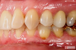 Przebarwienia zębów w strefach bocznych - sięgały zębiny i pomimo nowych wypełnień zachowały szary odcień - strona lewa