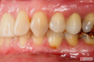 Przebarwienia zębów w strefach bocznych - sięgały zębiny i pomimo nowych wypełnień zachowały szary odcień - strona lewa Przebarwienia zębów w strefach bocznych - sięgały zębiny i pomimo nowych wypełnień zachowały szary odcień - strona lewa