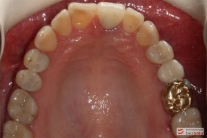 Pozostawiono złote onlay'e z uwagi na szczelność i bardzo dobrą kondycję - łuk górny Pozostawiono złote onlay'e z uwagi na szczelność i bardzo dobrą kondycję - łuk górny