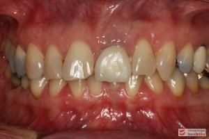 Zęby górne i dolne w zwarciu - liczne dyskoloracje i asymetria siekaczy centralnych w szczęce