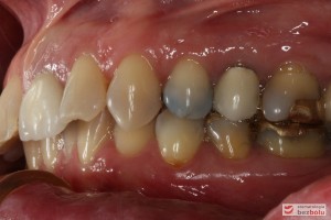 Powierzchnie wargowe zębów w zgryzie - widoczna ciemnoszara barwa przedtrzonowców i trzonowców - strona lewa
