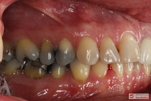 Powierzchnie wargowe zębów w zgryzie - widoczna ciemnoszara barwa przedtrzonowców i trzonowców - strona prawa