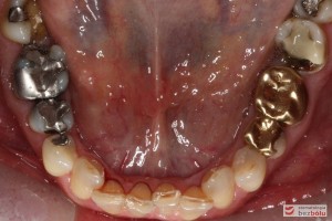 Powierzchnia okluzyjna zębów na dole - liczne wypełnienia amalgamatem i złote onlay'e - łuk dolny