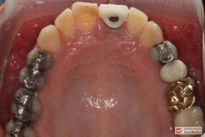 Powierzchnia okluzyjna zębów górnych - liczne wypełnienia amalgamatem, złoty onlay i nieszczelne komory - łuk górny