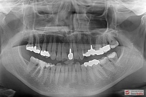 Diagnostyka radiologiczna - ocena kondycji tkanek oraz zastanych uzupełnień zębowych