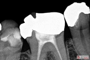 Leczenie kanałowe - przeleczenie i uszczelnienie kanałów w trzonowcu i przedtrzonowcu Leczenie kanałowe - przeleczenie i uszczelnienie kanałów w trzonowcu i przedtrzonowcu