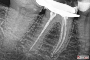 Leczenie kanałowe - przeleczenie i uszczelnienie kanałów w trzonowcu i przedtrzonowcu