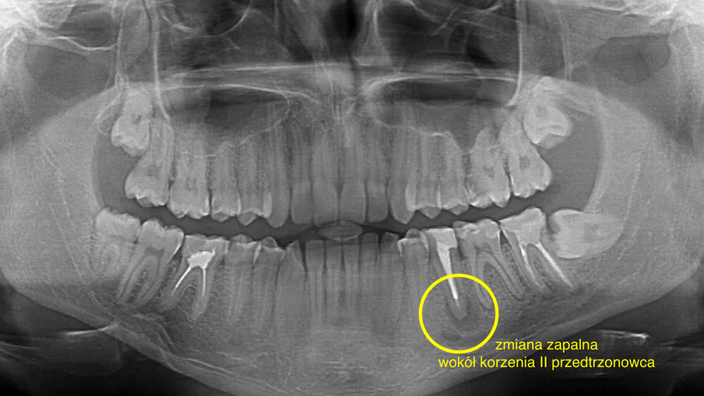 zmiana zapalna w drugim przedtrzonowcu w żuchwie po lewej stronie