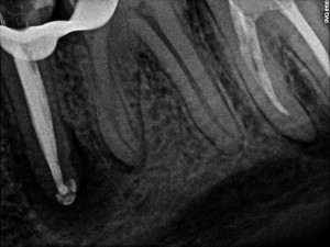 Drugi przedtrzonowiec w żuchwie po lewej stronie - Status kliniczny zaraz po zakończonym leczeniu endodontycznym