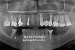 Zdjęcie pantomograficzne przedstawiające ząb po wykonaniu zabiegu hemisekcji.