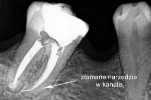 Na zdjęciu RVG widoczne jest złamane narzędzie w kanale. Ząb zakwalifikowano do zabiegu hemisekcji.
