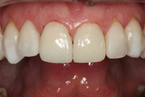 Ostateczna praca w jamie ustnej - licówka i korona siekaczy centralnych in situ