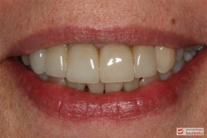 Efekt końcowy leczenia - nowe zęby w uśmiechu