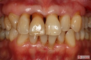 Zęby w zwarciu - widok frontalny, zgryz krzyżowy w pozycji kłów, paradontalny status siekaczy