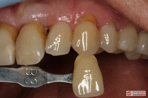 Dobór koloru dla nowych zębów - dobór koloru w odniesieniu do górnego kła po lewej stronie