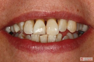 Usta w średnim uśmiechu - trójkątne przestrzenie między zębami w szczęce