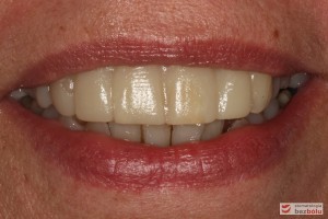 Mock-up w średnim uśmiechu - ocena stosunku brzegów siecznych do wargi dolnej