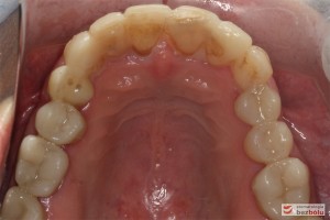 Powierzchnia okluzyjna w szczęce - ocena mock-up na zębach przednich, wypełnienia zębów bocznych