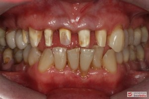 Oba łuki w zgryzie - widok frontalny, opracowane filary protetyczne na zębach własnych w szczęce