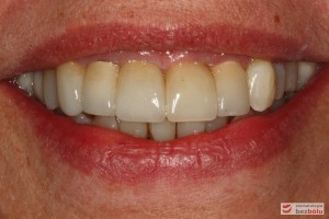Usta w uśmiechu pełnym - ocena stosunku brzegów siecznych do wargi dolnej