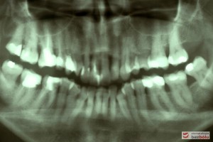 Kontrola radiologiczna - liczne zęby z niekompletną endodoncją, ubytek kości w szczęce