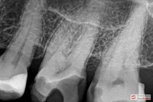 Radiowizjografia - ocena bliskości komory zęba w stosunku do preparacji