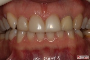 Zęby w zwarciu - widok frontalny, kieł prawy nie osiąga płaszczyzny okluzyjnej, nieregularna linia dziąsłowa
