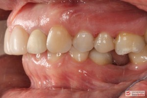 Zęby w zwarciu - strona lewa, brak szóstki dolnej, szóstka górna przekracza płaszczyznę okluzyjną, II klasa kłowa