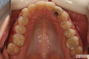Szczęka - widok okluzyjny, nieregularny kształt łuku zębowego, metal na dwójce górnej