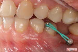 Mikrośruba ortodontyczna - 5 dolna lewa aktywowana do miniimplantu w celu dowargowego wychylenia