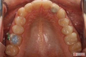 Szczęka - widok okluzyjny, dowargowe i doszczytowe przemieszczenie 6 prawej za pomocą mikrośruby ortodontycznej
