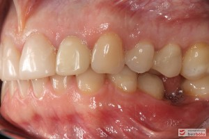 Zęby w zgryzie - strona lewa, przechylenie dojęzykowe piątki w żuchwie