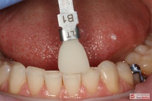 Dobór koloru - dostosowanie dla licówek do zębów w obu łukach