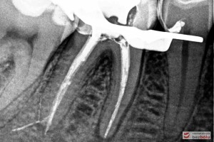 Leczenie endodontyczne - ocena szczelności wypełnienia kanałów szóstki po prawej stronie w żuchwie