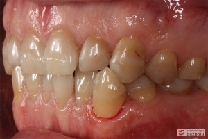 Zęby w zwarciu - strona lewa, kieł w zgryzie krzyżowym i znacznie starte zęby boczne
