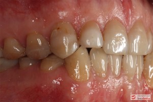 Zęby w zwarciu - strona prawa, przebarwienia świadczące o chorobie szkliwa (hypoplazja)